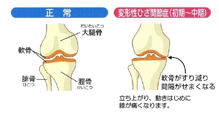 変形性膝関節症のイラスト（中期）